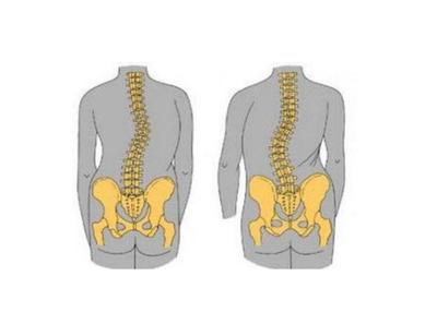 直到现在还困扰“周杰伦”的一种疾病:强直性脊柱炎,到底是什么来路?(下)