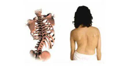 女性强直性脊柱炎的症状是什么 要怎么治疗