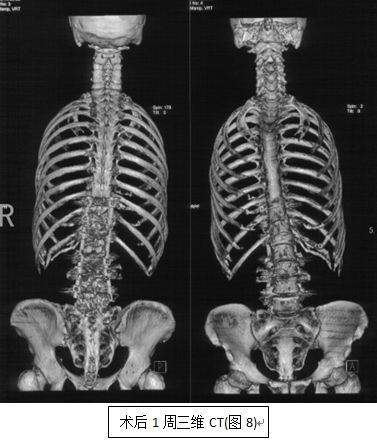 强直性脊柱炎后凸畸形 成因、症状与治疗