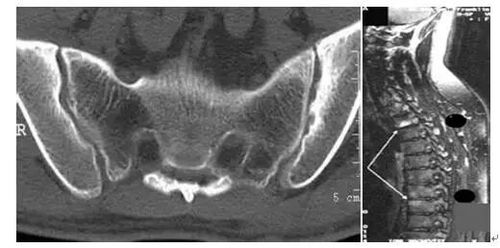 强直性脊柱炎疼痛部位及特点汇总分析