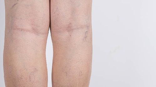 小儿痉挛性癫痫与强直性脊柱炎 症状解析