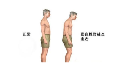 患有强直性脊柱炎会不会遗传给下一代?_健康_网