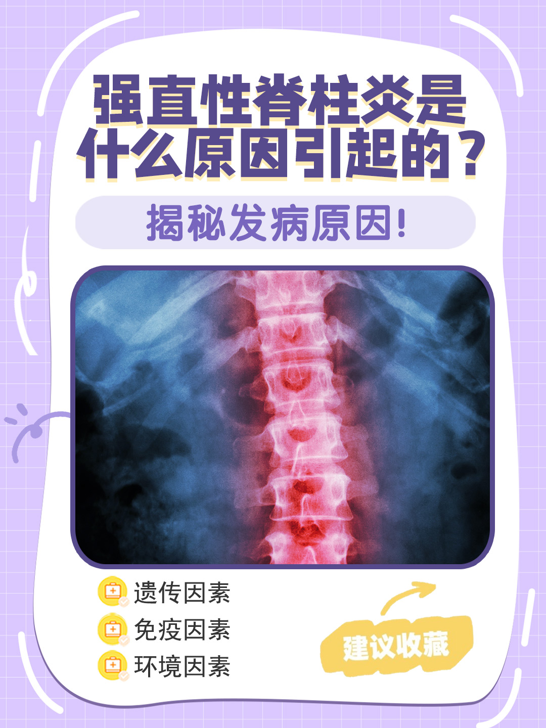 强直性脊柱炎 一种主要累及中轴骨骼的慢性炎症性疾病