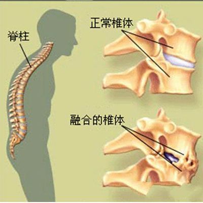 强直性脊柱炎的克星 小针刀疗法的综合应用