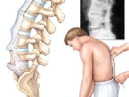 强直性脊柱炎治疗费用解析 从诊断到长期管理需要多少钱？